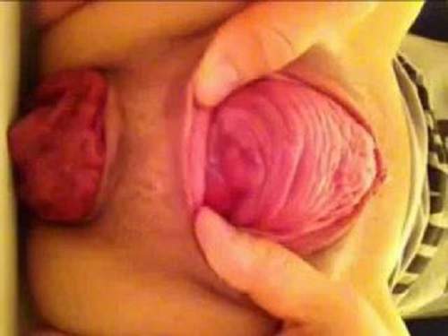 Closeup – Amateur mature colossal cervix and prolapse anus