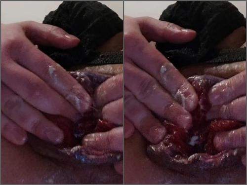 Closeup – Very closeup extreme ruination shocking size anal prolapse